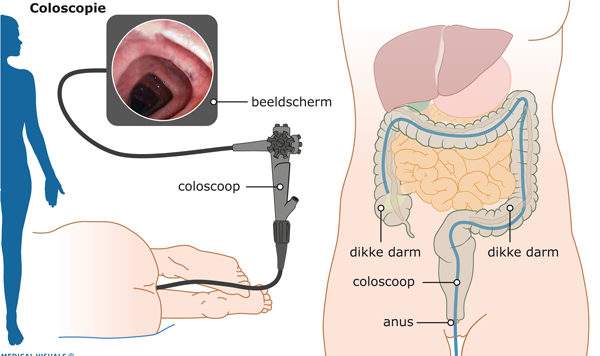 Ik krijg een kijkonderzoek van de darm (coloscopie) | Thuisarts