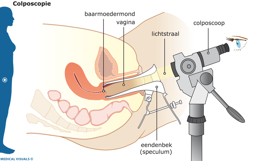 Afbeelding van een kijkonderzoek van de baarmoederhals (colposcopie)