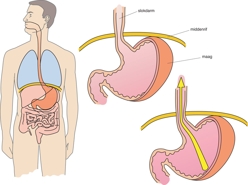 Afbeelding van de maag en slokdarm bij refluxklachten