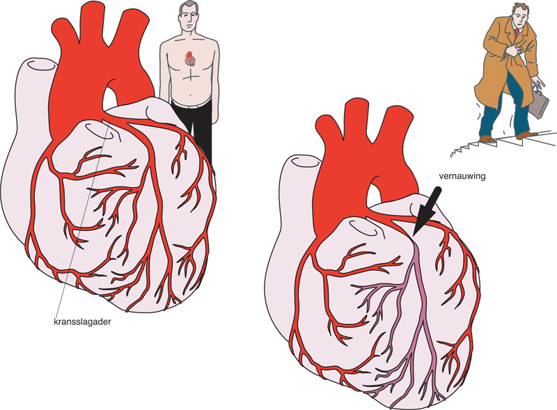Afbeelding van een nauwer geworden kransslagader bij iemand met hartkramp