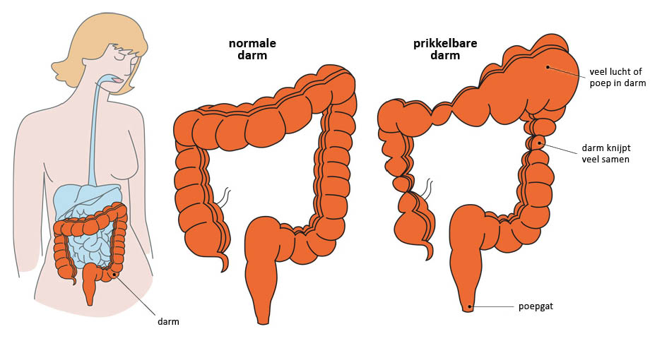 Een normale darm en een prikkelbare darm (PDS)