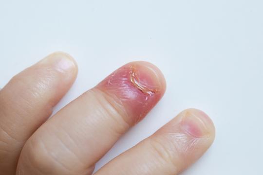 Ik een nagelriemontsteking | Thuisarts.nl